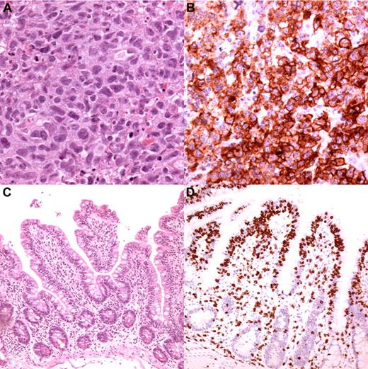 Figure 1. Typical EATL type 1 histology from one of the cases in the study. (A) The cells are large with irregularly shaped or angulated nuclei and a variable amount of cytoplasm (magnification, 250×). (B) The cells in this case expressed CD30 (magnification, 250×). The mucosa adjacent to the tumor had shortened villi (C; magnification, 100×) and “top-heavy” intra-epithelial infiltration by T cells (D; CD3 staining, magnification, 100×).