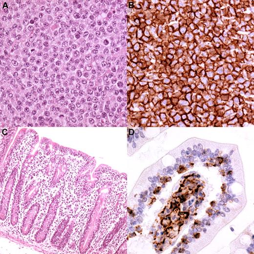 Figure 2. Typical EATL type 2 histology from one of the cases in the study. (A) The lymphoma consists of monotonous, medium-sized cells with round nuclei having a stippled chromatin pattern (magnification, 250×). (B) The cells express CD56 (magnification, 250×). The mucosa adjacent to the lymphoma, shows villous atrophy (C; magnification, 100×) and intra-epithelial infiltration by lymphoma cells (D; CD56 staining, magnification, 400×).