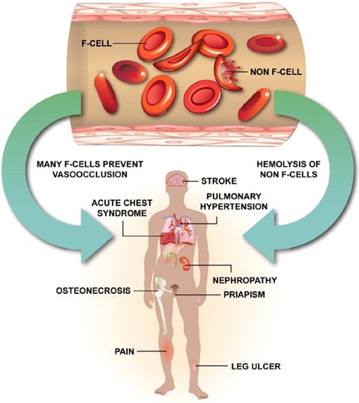 Figure 1. Sickle erythrocytes are a mixture of cells with measurable HbF (F cells) and non-F cells. F cells are long lived, do not acquire the same increment of HbS-induced damage as non-F cells, are less likely to initiate adhesive events, and are associated with protection from sickle vaso-occlusion (left arrow). The heterocellular distribution of HbF in sickle cell anemia, even when total HbF concentrations are high at baseline or in response to hydroxyurea, means that some erythrocytes with no HbF or with suboptimal concentrations of HbF are present. Some of these cells hemolyze intravascularly liberating hemoglobin, which scavenges nitric oxide and contributes to certain vascular complications of this disease (right arrow). This might account for the failure of high HbF that is heterocellularly distributed to protect against all disease complications.