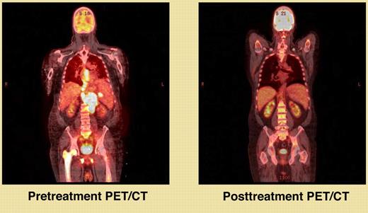 Pretreatment and posttreatment PET/CT scans.