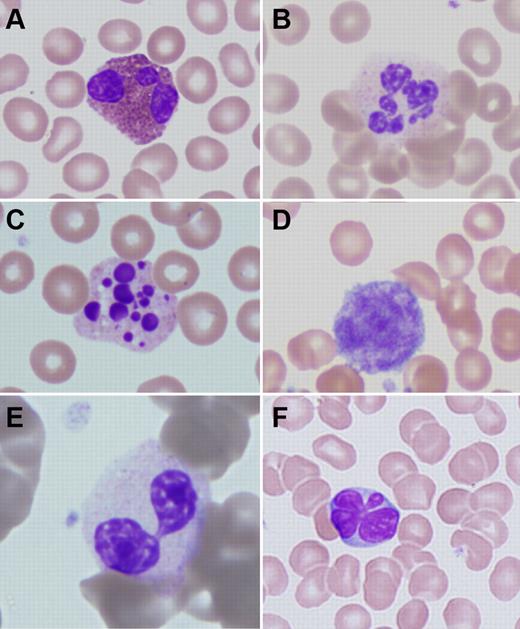 Figure 1. Peripheral blood abnormalities in patients with ADA-SCID. (A) Trilobed eosinophil from patient ADA1. (B) Hyperlobular neutrophil from patient ADA14. (C) Pyknotic neutrophil from patient ADA3. (D) Giant platelet from patient ADA14. (E) Pseudo-Pelger-Hüet cell from patient ADA16. (F) Atypical lymphocyte from patient ADA10. Slides were stained with Wright-Giemsa. Images were obtained via digital microscopy using an Olympus BX-51 microscope equipped with a DPlan 40×/0.65 numeric aperture objective and captured using an Olympus DP70 digital camera system. Microsoft PowerPoint was used to assemble the panels into 1 figure. (A-F) Original magnification ×1000.