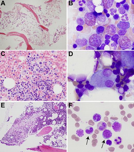 Figure 2. Bone marrow abnormalities in patients with ADA-SCID. (A) Hypocellular biopsy from patient ADA1 at 21 years of age. (B) Left-shifted eosinophilia in patient ADA6. (C) Atypical, mononuclear megakaryocytes in a clot section from patient ADA16. (D) Dysplastic megakaryocyte with separated nuclear lobes in patient ADA6. (E) Area of atypical fibrosis in the marrow biopsy of patient ADA10. (F) Hypogranular granulocytic precursor and megaloblastoid erythroid precursor (arrows) in the marrow aspirate of patient ADA10. Biopsies were stained with hematoxylin and eosin and aspirates with Wright-Giemsa. Images were obtained via digital microscopy using an Olympus BX-51 microscope equipped with a DPlan 40×/0.65 numeric aperture objective and captured using an Olympus DP70 digital camera system. Adobe Photoshop CS3 was used to assemble the panels into one figure. (A,E) Original magnification ×40. (B,D,F) Original magnification ×1000. (C) Original magnification ×200.