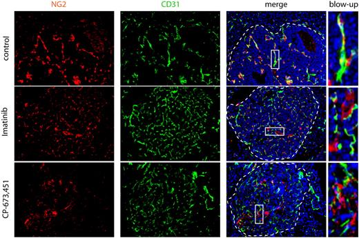 Figure 1. Pericytes are dissociated from ECs on treatment with PDGFR inhibitors. Treatment of RIP1-Tag2 mice with imatinib or CP-673,451 induces pericyte detachment in PNET (arrows). RIP1-Tag2 mice were treated with imatinib (150 mg/kg a day; n = 10) or CP-673,451 (50 mg/kg a day; n = 5) for 5 days by oral gavage. Pictures show immunostaining for CD31 (green) and NG2 (red) on cryosections. Arrows indicate tightly associated (control) or dissociated (imatinib and CP-673,451) pericytes in the tumor vasculature. Dotted line marks tumor:exocrine pancreas boundary. Cell nuclei (DAPI), blue. Boxes indicate areas shown in higher magnification in the right panel. Original magnification, 200×. The panels are representative of at least 5 fields in 5 tissue sections taken from 5 mice.