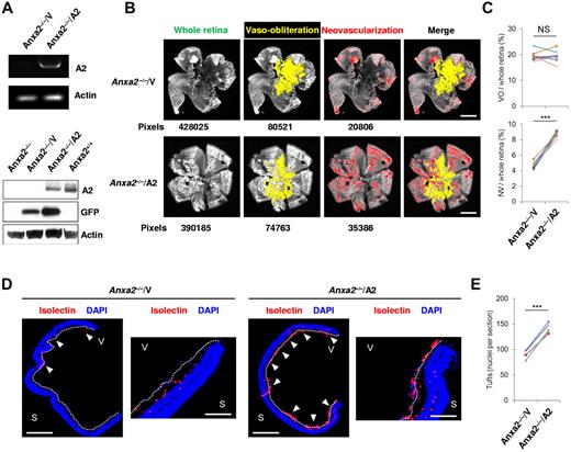 Figure 2. Reexpression of annexin A2 restores neoangiogenesis in OIR. (A) RT-PCR of retinal tissue at P14 after subretinal injection of A2-encoding (A2; OD) or empty (V; OS) adenovirus in Anxa2−/− mice at P12, and immunoblot analysis of identically treated Anxa2−/− mouse retinas 2 days (P14) after virus injection. The data are representative of 3 independent experiments. (B) Representative retinal images showing total retinal area and regions of NV and VO in oxygen-treated P17 Anxa2−/− mice injected with either A2-encoding or empty virus on P12. Pixel number corresponding to each compartment is indicated below each image. (C) Ratios of VO to total retinal area (19.5% ± 0.64% vs 19.4% ± 0.79%) and NV to total retinal area (4.7% ± 0.15% vs 8.6% ± 0.12%) in P17 oxygen-treated Anxa2−/− mice injected with either empty or A2-encoding virus (n = 8; NS indicates no significant difference, ***P < .001). (D) Representative retinal cross-sections (magnification ×40), with a close-up view of the peripheral region (magnification ×200) of retinas from P17 oxygen-treated Anxa2−/− mice injected with empty or A2-encoding virus stained with DAPI (blue) and isolectin B4 (red). Neovascular tufts penetrating the inner limiting membrane (highlighted with a white dashed line) are indicated by arrowheads. (E) Enumeration of neovascular nuclei in retinal sections from P17 oxygen-treated Anxa2−/− mice injected with empty versus A2-encoding virus (88 ± 4.2 vs 134 ± 3.5; n = 5; ***P < .001). S indicates sclera; V, vitreous body. Scale bars, 200 μm (B; magnification ×50), 500 μm (D; magnification ×40), 100 μm (D; magnification ×200).
