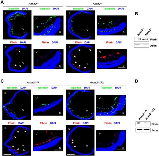 Figure 5. The annexin A2 system promotes retinal neoangiogenesis in OIR by enhancing fibrin clearance. (A) Representative cross-sections (magnification ×40) of retinas, from P17 oxygen-treated Anxa2+/+ and Anxa2−/− mice, stained with DAPI (blue), isolectin B4 (green), and anti-fibrinogen (red). Close-up views of the peripheral retina are also shown (magnification ×200). Fibrin deposition is indicated by arrowheads. (B) Representative immunoblot of fibrin within retinal tissue from P17 oxygen-treated Anxa2+/+ and Anxa2−/− mice. (C) Representative cross-sections (magnification ×40) of retinas from P17 oxygen-treated Anxa2−/− mice injected with either empty (V) or A2-encoding (A2) virus, stained with DAPI (blue), isolectin B4 (green), and anti-fibrinogen (red). Close-up views of the peripheral retina are also shown (magnification ×200). Fibrin deposition is indicated by arrowheads. (D) Representative immunoblot of fibrin within retinal tissue from P17 oxygen-treated Anxa2−/− mice injected with empty or A2-encoding virus. S indicates sclera; V, vitreous body. Scale bars, 500 μm (A; magnification ×40) and 100 μm (C; magnification ×200). The data are representative of 5 (A,C) and 3 (B,D) independent experiments.