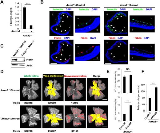 Figure 6. Fibrinogen depletion enables neovascularization of the Anxa2−/− retina. (A) ELISA of fibrinogen levels in plasma from P17 Anxa2−/− mice treated with (0.19 ± 0.04 mg/mL; n = 7) or without (1.17 ± 0.09 mg/mL; n = 8) ancrod (***P < .001). (B) Representative cross-sections (magnification ×40) of retinas from P17 oxygen-treated Anxa2−/− mice treated thereafter with or without ancrod and stained with DAPI (blue), isolectin B4 (green), and anti-fibrinogen (red). Close-up views of the peripheral retina are also shown (magnification ×200). S indicates sclera; V, vitreous body. Scale bars 500 and 100 μm, for magnification ×40 and ×200, respectively. (C) Representative immunoblot of fibrin in retinal tissue from P17 oxygen-treated Anxa2−/− mice treated thereafter with or without ancrod. (D) Representative images showing total retinal area and regions of AV and VO from P17 oxygen-treated Anxa2−/− mice treated thereafter with or without ancrod. Pixel number corresponding to each compartment is indicated below each image. Scale bars, 200 μm (magnification ×50). (E) Ratios of areas of VO to total retina (27.2% ± 1.7% vs 30.1% ± 1.3%) and NV to total retina (4.3% ± 0.09% vs 9.7% ± 0.2%) in P17 oxygen-treated Anxa2−/− mice treated thereafter with or without ancrod (n = 5; NS indicates no significant difference, *** P < .001). (F) Enumeration of neovascular nuclei in retinal sections from P17 oxygen-treated Anxa2−/− mice treated thereafter with (131.8 ± 5.3 nuclei per section) or without ancrod (79.4 ± 2.2 nuclei per section; n = 5; ***P < .001). The data are representative of 5 (B) or 3 (C) independent experiments.