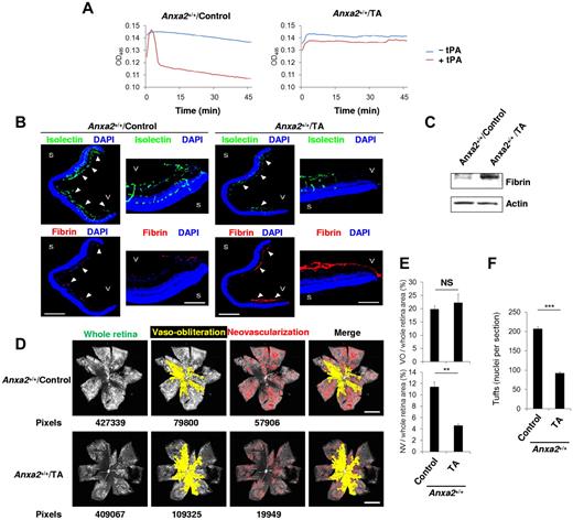 Figure 7. Interruption of fibrinolysis blocks retinal neoangiogenesis during OIR. (A) Clot lysis curves representative of ≥ 3 assays (n = 4 for each) performed with plasma from P17 Anxa2+/+ mice treated with or without TA. (B) Representative cross-sections (magnification ×40) of retinas from P17 oxygen-treated Anxa2+/+ mice treated with or without TA and stained with DAPI (blue), isolectin B4 (green), and anti-fibrinogen (red). Close-up views of the peripheral retina (magnification ×200) are also shown. Fibrin deposition is indicated by arrowheads. S indicates sclera; V, vitreous body. Scale bars 500 and 100 μm for magnification ×40 and ×200, respectively. (C) Representative immunoblot of fibrin in retinas from P17 oxygen-treated Anxa2+/+ mice treated with or without TA. (D) Representative images from P17 oxygen-treated Anxa2+/+ mice treated with or without TA, showing total retinal area and regions of VO and NV. Pixel number corresponding to each compartment is indicated below each image. Scale bars, 200 μm (magnification ×50). (E) Ratios of VO to total retinal area (19.8% ± 1.3% vs 22.2% ± 3.3%) and NV to total area (11.4% ± 0.9% vs 4.6% ± 0.3%) in retinas from P17 oxygen-treated Anxa2+/+ mice treated with or without TA (n = 4; NS indicates no significant difference, ***P < .001). (F) Enumeration of neovascular nuclei in retinas from P17 oxygen-treated Anxa2+/+ mice treated with (92 ± 4.0; n = 5) or without TA (207 ± 5.9; n = 3; ***P < .001). The data are representative of 5 (B) or 3 (C) independent experiments.