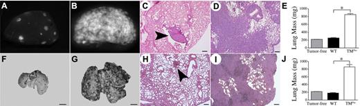 Figure 1. TMPro mice exhibit a profoundly prometastatic phenotype relative to WT mice. Gross appearance of representative single lung lobes harvested from a WT (A) and TMPro mouse (B) 13 days after IV injection of 3 × 105 LLCGFP cells viewed under a fluorescence stereoscope. Note the overwhelming amount of GFP+ tumor tissue in the TMPro lung lobe in panel B relative to the WT animal in panel A. H&E stained sections of lung tissue revealed small, discreet metastatic foci (arrowhead) in lungs from WT mice (C), whereas lungs harvested from TMPro mice were largely effaced by tumor tissue (D). (E) Consistent with the apparent increase in tumor burden, the weight of lung tissue harvested from LLCGFP-challenged TMPro mice was significantly greater than that of lungs harvested from LLCGFP-challenged WT mice, or lungs from tumor-free animals. Similar findings were observed in cohorts of WT and TMPro mice intravenously injected in parallel with B16 melanoma cells. Shown are representative whole lungs from WT (F) and TMPro mice (G) as well as H&E-stained sections of lung tissue from WT (H) and TMPro mice (I). (J) Also paralleling results with LLC cells, the weight of lungs harvested from B16-challenged TMPro mice was significantly greater than that of lungs harvested from B16-challeged WT mice or tumor-free animals. Size bars represent 200 μm (C-D,H-I) or 250 mm (F-G). Data represents mean and SEM, *P < .005.