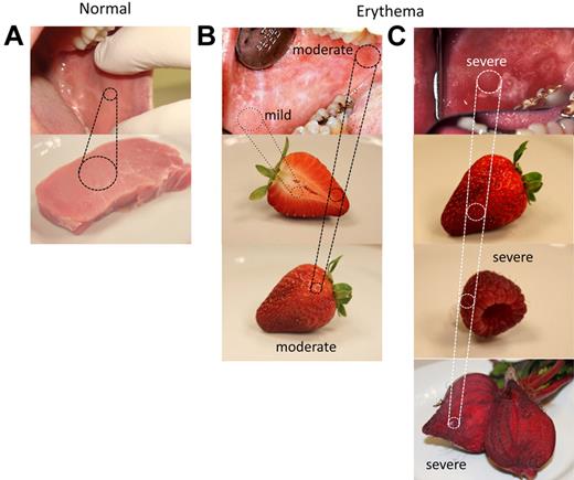 Figure 3. Frame of reference for grading oral erythema. (A) Normal mucosa has the approximate color of uncooked lean pork. (B) Mild erythema appears similar to the inner part of an almost ripe strawberry; and moving outwards, the more intense color of the skin approximates moderate erythema. (C) Severe erythema is most often the color of a fully ripened strawberry, raspberry, or red beet.