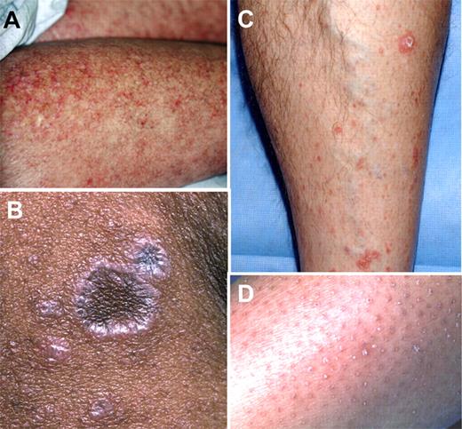 Figure 5. Lesions included in the NIH category of erythema. (A) Poikiloderma. (B) Lichen-planus like. (C) Papulosquamous plaques. (D) Keratosis pilaris–like lesions.