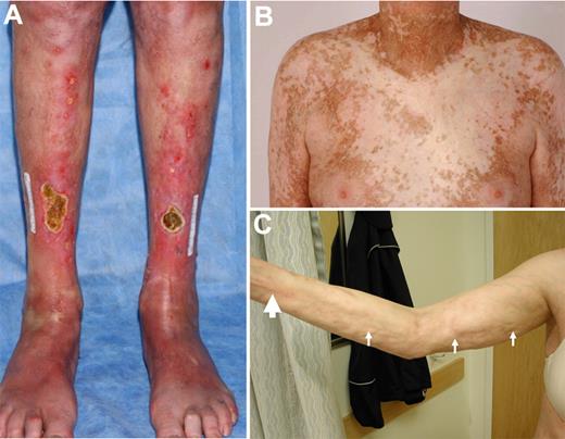 Figure 6. Morphea- and sclerodermatous-like cGVHD. (A) Hidebound sclerosis with significant erythema and skin ulcerations. (B) Morphea that is categorized under moveable sclerosis by NIH or VSS 2, and the thickened skin is associated with overlying hypopigmentation and also adjacent hyperpigmentation. (C) Deep sclerosis of the arm showing skin dimpling (thin arrows) and groove sign (thick arrow).