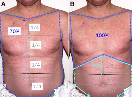 Figure 7. Estimating the percentage of skin involvement within a body area. (A) NIH scoring of erythema for the NIH anterior torso body area (dark blue dashed line) involves dividing the area into fourths using your mind's eye, drawing a line of best fit across the lower edge of erythema, to arrive at ∼ 70% involvement. (B) VSS of erythema for the anterior torso involves scoring for 2 body areas. The chest body area (dark blue dashed line) is 100% involved. The abdomen and genitalia body area (light blue dashed line) is divided into thirds using your mind's eye, and a line of best fit across the lower edge of erythema leads to ∼ 35% involvement.