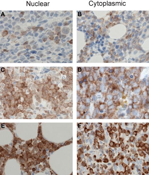 Figure 1. MSI2 staining intensities. Representative images are shown for 1+, 2+, and 3+ MSI2 staining in the nuclear and cytoplasmic compartments. Specifically, 1+ intensity is shown for nuclear (A) and cytoplasmic (B) staining, 2+ intensity for nuclear (C) and cytoplasmic (D) staining, and 3+ intensity for nuclear (E) and cytoplasmic (F) staining. (A-F) Original magnification ×400; sections were stained with diaminobenzidine and H&E. Manual analysis derived H-scores for nuclear and cytoplasmic MSI2 staining (as detailed in “Methods”) and Aperio image analysis measured nuclear and total cellular (combined nuclear and cytoplasmic) staining, using the illustrated intensity cut-offs. Micrographs were imaged using a Nikon Eclipse 80i microscope, with a Nikon Plan Apo 40×/0.95 air objective and captured using a Nikon DS-F digital camera with NIS-Elements D 3.1 software, with manipulation in CorelDRAW X3.