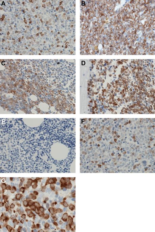 Figure 4. Patterns of MSI2 expression. (A) MSI2 protein expression was usually present in relatively infrequent cells scattered in an interstitial pattern. (B) Occasional cases showed positive MSI2 staining in confluent sheets of cells. (C) A “watershed” interface was frequently present at the edge of confluent sheets of MSI2-positive cells, and the positive cells merged with negative adjacent cells at an irregular interface. (D) Confluent sheets of MSI2-positive cells were frequently paratrabecular. (E) Admixed non-neoplastic cells, particularly myeloid and erythroid precursors, and megakaryocytes, were negative for MSI2. (F) Occasional cells showed strong nuclear MSI2 staining and weak cytoplasmic staining, but these were infrequent, whereas frequently large blasts showed strong to medium cytoplasmic staining and weak or negative nuclear staining (G). (A-G) Original magnification ×600. Micrographs were imaged using a Nikon Eclipse 80i microscope, with a Nikon Plan APO 60×/1.40 oil objective under oil and captured using a Nikon DS-F digital camera with NIS-Elements D 3.1 software, with manipulation in CorelDRAW X3.