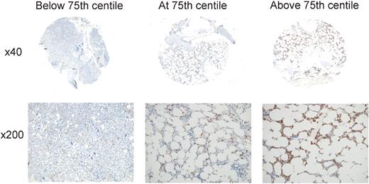 Figure 6. MSI2 expression levels associated with outcome. Representative cores are shown for percentage MSI2 positivity below (A), at (B), or above (C) the 75th centile, illustrating the relatively low abundance of positive cells associated with poorer outcome (B-C). For each core, the entire core is shown (original magnification ×40) and a representative inset below (original magnification ×200). Micrographs were imaged using a Nikon Eclipse 80i microscope and captured using a Nikon DS-F digital camera with NIS-Elements D 3.1 software, with manipulation in CorelDRAW X3. For each core the entire core was imaged using a Nikon Fluor Apo 4×/0.13 air objective and a representative high power image with a Nikon Plan Apor 20×/0.75 air objective.