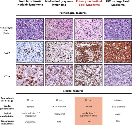 Figure 1. Pathologic and clinical features of PMBCL compared with related diseases. (Top panel) Representative H&E and immunohistochemical stains. Positivity of CD20 and CD30 in PMBCL is characteristic, although not mandatory, for the diagnosis of PMBCL. The H&E stain of PMBCL shows typical sheets of medium-sized to large cells containing abundant pale cytoplasm in a background of fine sclerosis. Of note, CD20 staining in nodular sclerosis subtype of cHL is typically heterogeneous, and CD30 is usually absent in DLBCL. (Bottom panel) The typical clinical features of PMBCL are given and contrasted with related entities.