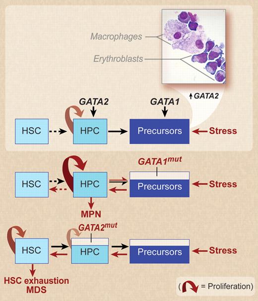 A model for the effect of stress on the hematopoietic compartments in the presence of wild-type GATA1 and GATA2 genes or in the presence of loss-of-function GATA1 and GATA2 mutations. In vitro models of stress erythropoiesis indicate that the stress signal increases the erythroid output by amplifying the hematopoietic progenitor cell compartments (HPCs) through increased levels of GATA2 expression.16 Surprisingly, in spite of the purity of CD34pos populations used to start the culture and the exclusively erythroid-permissive culture conditions used, macrophages are always detected in these cultures and erythroblastic-island–like structures (inset, kindly provided by Migliaccio laboratory) are frequently observed on smears prepared with erythroid cells expanded under stress conditions. In the presence of GATA1mut, which impairs the maturation potential of the precursor compartments, stress must induce an even greater expansion of the HPC compartment leading to the development of myeloproliferative neoplasms (MPNs)8,16; however, the amplification potential of the HPCs is sufficient to increase the precursor cell demand necessary to respond to stress, leaving the hematopoietic stem cell compartment (HSC) unstimulated. In contrast, the presence of a loss-of-function GATA2 mutation hampers HPC proliferation, reducing in turn the numbers of precursor cells generated by the HPCs. An effective response to the increased precursor cell demand induced by stress requires the generation of new HPCs from the HSC compartment, resulting, if the stress is prolonged, in HSC exhaustion and MDS. Professional illustration by Debra T. Dartez.