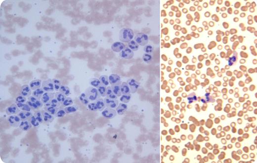 A 13-year-old girl with juvenile rheumatoid arthritis presented for a routine examination. Except for a short episode of a cough 1 week prior, she had no complaints. The chest examination was normal. / Blood cell count was performed on an automated analyzer using an ethylenediaminetetraacetic acid (EDTA) blood specimen and showed normal hemoglobin and leukocytes (7.2 × 109/L), but a mild thrombocytosis (467 × 109/L). Platelet clumps were flagged by the cell counter. However, when the peripheral smear was reviewed, there was leukocyte agglutination (shown, left) rather than clumps of platelets. The cold agglutinin test was positive with relative anti-I specificity. Serology for Mycoplasma pneumoniae was positive (complement fixation test 1:32, reference value ≤ 1:16; microparticles agglutination 1:1280, reference value ≤ 1:40). When the blood was warmed at 37°C, the smear no longer showed leukoagglutination (shown, right). / The cause of leukoagglutination in this case was uncertain, but connective tissue disease and Mycoplasma infection were possibilities. Leukoagglutination has also been reported in other types of infections, inflammation, malignancies, alcoholism, and liver disease, and with blood storage. At times, an EDTA-dependent leukoagglutination can occur in healthy subjects; this possibility was not tested in this case.