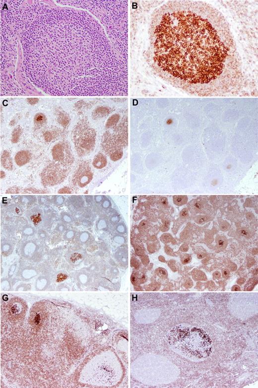 Figure 1. FLIS. (A-B) H&E-stained (A) and BCL2-stained (B) sections of LN showing replacement of a germinal center by centrocytes with uniformly intense positivity for BCL2. The surrounding mantle cuff is intact and shows relatively weak BCL2 positivity. Original magnification ×200. (C-D) FLIS in an LN stained for BCL2 (C) and CD10 (D). The single involved follicle is strongly positive for BCL2 and CD10. Mantle zone B cells and T cells show less intense BCL2 positivity. Normal germinal centers are BCL2− and only dimly CD10+. Original magnification ×40. (E-G) Several examples of FLIS patterns. (E-F) LNs with overall intact architecture but with the minority (E) or majority (F) of follicle centers involved by FLIS. Original magnification ×20. The individual follicles exhibit various degrees of involvement by FLIS cells (G), and a similar pattern is seen in a case from a patient who had a prior history of follicular lymphoma (H; case 23 in Table 3). Original magnification ×40.