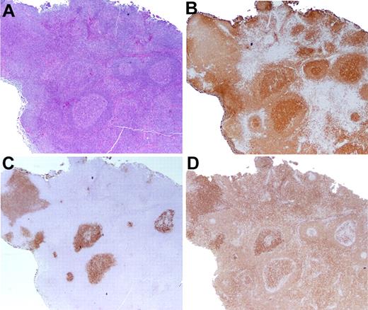 Figure 2. Partial LN involvement by FL. (A-B) In distinction from FLIS, the follicles are expanded in size (A), and clustered in 1 portion of the LN, as highlighted by CD20 immunohistochemistry (B). (C) CD10 staining shows that the margins of the atypical follicles are slightly blurred and not sharply defined. (D) The BCL2 stain is more variable in intensity than is typical for FLIS. Original magnification ×20.