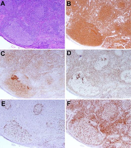 Figure 3. BCL2− FL with an in situ FLIS component. (A-B) The LN exhibits a proliferation of large follicles lacking polarization, highlighted by the CD20 stain (B). (C-D) A CD10 stain (C) demonstrates more intense staining of the FLIS component than the FL component, and the BCL2 stain (D) highlights the intensely staining FLIS component, whereas the FL is BCL2−. (E-F) A MIB-1 stain (E) identifies a low proliferation rate within the abnormal follicle, and a CD3 stain (F) reveals admixed T cells. Original magnification ×40. Case 29 in Table 3.