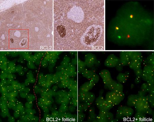 Figure 4. FISH of FLIS. (Top panels) Two FLIS follicles stained for BCL2. FISH was examined in follicular and interfollicular areas. Within the FLIS follicle, a cell shows a split red and green signal, indicating a BCL2 break (top right). (Bottom panels) Cells with split signals are seen only in involved follicle, to right of dotted line, and not in uninvolved areas, to left of dotted line. The involved follicle is shown at higher power (bottom right).