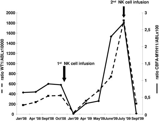 Figure 6. Clinical outcome after NK-cell infusion of 1 patient with AML harboring inv(16) in early molecular relapse. Because adequate numbers of donor NK cells were available, a second NK-cell infusion, after immunosuppressive chemotherapy, was performed at the time of the second relapse. The figure shows the value of both WT1 and CBF molecular transcript at different time points.