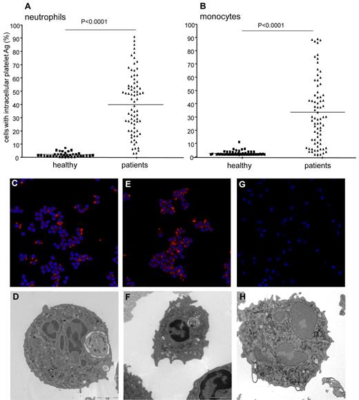 Figure 1. Phagocytosed platelets in leukocytes from patients with PV or ET. The presence of neutrophils and monocytes with intracellular platelets was assessed by flow cytometry and confocal and electron microscopy, as described in “Flow cytometry” and “Confocal microscopy and electron microscopy.” For confocal microscopy, platelets were identified based on the expression of the glycoprotein Ib (red). Hoechst stain (blue) was used for counterstaining nuclei. (A) Symbols represent the fraction of neutrophils with intracellular platelet antigens. Horizontal lines indicate mean values. (B) Symbols represent the percentage of monocytes with intracellular platelet antigens. Horizontal lines indicate mean values. Representative confocal (panels C,E,G) and electron microscopy (panels D,F,H) images of neutrophils from a patient with PV (panels C-D), from a patient with ET (panels E-F), and from a healthy control (panels G-H) are shown.