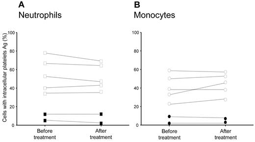 Figure 3. Hydroxyurea treatment and platelet clearance in PV and ET patients. The presence of leukocytes with intracellular platelets was assessed by flow cytometry in the blood of 7 patients studied before and after hydroxyurea treatment, as described in the text. Symbols represent the percentage of neutrophils (A) and monocytes (B) with intracellular platelet antigens. Filled symbols indicate patients with previous thrombotic episodes.