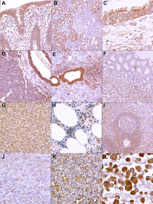 Figure 2. Reactivity of the recombinant antibodies in diverse tissues and cells. The antibodies stain cytoplasmic autoantigens in a diverse array of cell types (immunoperoxidase staining): (A) colonic epithelial cells in the appendix (mAb 25; magnification ×200); (B) tubular epithelial cells in the kidney (mAb 129; magnification ×100); (C) respiratory epithelial cells in the bronchus (mAb 10; ×400); (D) pancreatic ductal epithelial cells as well as exocrine secretory cells (mAb 129; ×200); (E) ductal epithelial cells in the salivary gland (mAb 25; ×200); (F) acinar cells in the stomach (mAb 10; ×100); (G) SMZL cells (mAb 10; ×400); (H) red cell precursor cells in the bone marrow (mAb 10; ×400); (I) marginal zone B lymphocytes in the spleen (mAb 129; ×100); (J) a subpopulation of monocytoid B cells in the lymph node (mAb 129; ×100);(K) tingible body macrophages in germinal centers from a lymph node (mAb 25; ×400); (L) cells of pancreatic carcinoma cell line PANC1 (mAb 25; ×400).