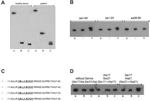 Figure 1. Identification of the phosphorylation site responsible for the hyperphosphorylation of paratarg-7. (A) Immunoelectrophoretic focusing after endopeptidase treatment of paratarg-7. IEF separation followed by immunodetection with anti-paratarg-7 resulted in an additional band of the patient's LCL lysate after trypsin treatment (C) and a modified migration of the chymotryptic fragment (B). The differences in migration of the immunopositive fragments in lanes B and C indicate a different electric charge of the fragments that are the result of the additional phosphorylation. Lane A indicates LCL lysate; lane B, LCL lysate incubated with chymotrypsin; and lane C, LCL lysate incubated with trypsin. (B) Identification of the phosphorylation site responsible for the hyperphosphorylation of paratarg-7 in patients with paratarg-7– specific paraproteins. A phosphorylation site located between aa 1 to 25 is responsible for the hyperphosphorylation of paratarg-7. Lane c indicates recombinant fragment without complementation as control; lane –, recombinant fragment incubated with an enzyme mix from LCLs of a healthy donor carrying wild-type paratarg-7; and lane +, recombinant fragment incubated with an enzyme mix derived from LCLs of a patient carrying hyperphosphorylated paratarg-7. (C) Mutagenization of paratarg-7 fragments containing aa 1 to 62. (D) Isoelectric focusing of the respective fragments shown in panel C. Only the fragment containing Ser17 shows the additional band representing the hyperphosphorylated peptide after complementation with an enzyme mix derived from a carrier of hyperphosphorylated paratarg-7. Lane a indicates expression of the mutagenized fragment as control; lane b, incubation with a native lysate of LCLs from a healthy donor carrying wild-type paratarg-7; and lane c, incubation with a native lysate of LCLs derived from a patient carrying hyperphosphorylated paratarg-7.