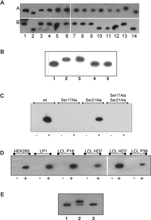 Figure 2. Identification of the kinase responsible for the hyperphosphorylation of paratarg-7. (A) Inhibition of kinases. LCLs derived from a healthy donor carrying wild-type paratarg-7 (row A) or a patient carrying hyperphosphorylated paratarg-7 (row B) were cultured in the presence of inhibitors (dissolved in DMSO) at the indicated concentrations. Lysates were analyzed by IEF and stained with anti-paratarg-7. Lane 1 indicates LCLs from healthy donor and patient, respectively, cultured with addition of DMSO (1:106) only. Hyperphosphorylation was inhibited by incubation with staurosporine (2.5μM, lane 2), ellagic acid (10μM, lane 10), and wortmannin (5nM, lane 11). No effect was observed by incubation with, lanes 3 to 9: H89 (50nM), Akt1,2 inhibitor (200nM), purvalanol (100nM), SL327 (200nM), SP600125 (100nM), SB202190 (50nM), and ZM447439 (1μM). As controls, lysates of healthy donor (lane 12), patient (lane 13), and recombinant paratarg-7 in Escherichia coli (lane 14) were also analyzed. Panel A is composed of 4 separate IEF gels. (B) Inhibition of paratarg-7 hyperphosphorylation by PKCζ pseudosubstrate in LCL derived from patients with pP-7. IEF followed by immunodetection of paratarg-7 in LCLs derived from healthy donor (lane 1) and from a patient (lane 2) as control. LCLs derived from a patient with pP-7 were cultured without inhibitors (lane 3) or in the presence of bisindolylmaleimide I (6μM, lane 4) or PKCζ pseudosubstrate (50μM, lane 5). (C) Demonstration of the direct interaction of Ser17 of paratarg-7 with PKCζ: only mutated fragments containing Ser17 interact with PKCζ. No interaction was detected when Ser was replaced by Ala. wt indicates unmutated paratarg-7 fragment spanning aa 1 to 60; Ser17Ala, fragment spanning aa 1 to 60 with Ser17 replaced by Ala; Ser21Ala, fragment spanning aa 1 to 60 with Ser21 replaced by Ala; Ser17Ala Ser21Ala, fragment spanning aa 1 to 60 with both serines replaced by Ala; –, control (carrier of wild-type paratarg-7 wtP-7); +, carrier of hyperphosphorylated paratarg-7 pP-7. (D) Coimmunoprecipitation of paratarg-7 and PKCζ in cell lines (HEK293, LP1) and LCLs derived from patients (P18, P39) and healthy donor (HD7). In the left portion of the panel, precipitation of the complex was done using anti-STOML2 (BD Biosciences) followed by detection of PKCζ in the redissolved precipitate using anti-PKCζ. In the right part of the panel, precipitation was done with anti-PKCζ followed by detection with anti-STOML2. – indicates precipitation was performed with an irrelevant secondary Ab; and +, as described before. (E) In vitro phosphorylation of paratarg-7 with PKCζ. In an in vitro experiment purified recombinant wild-type paratarg-7 was incubated with recombinant PKCζ in the presence or absence of PKCζ pseudosubstrate. The figure shows an IEF followed by immunodetection of paratarg-7. 1 indicates recombinant E coli paratarg-7; 2, recombinant E coli paratarg-7 (0.5 μg) phosphorylated with recombinant PKCζ (0.5 μg) in the absence or 3, presence of PKCζ pseudosubstrate (50μM).