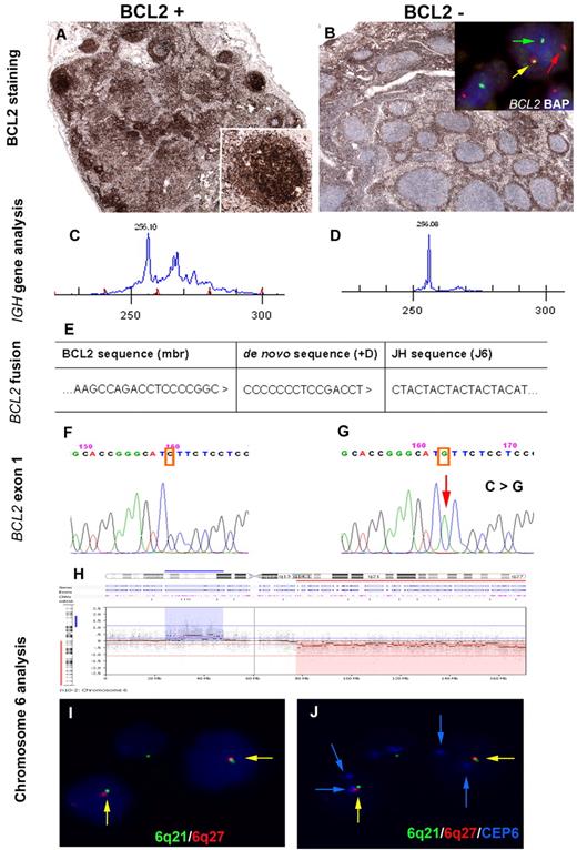 Figure 1. Immunophenotypic, molecular, and molecular cytogenetic findings in a synchronous, clonally related in situ and manifest follicular lymphoma. Immunohistochemical analysis of BCL2. (A) BCL2 expression in some germinal centers of a morphologically reactive lymph node. Inset: higher magnification of a BCL2 positive germinal center. (Labvision, BCL2 clone 100/D5). (B) Lymph node biopsy with the manifest follicular lymphoma, BCL2 negative. Insert: Interphase FISH analysis using double-color BCL2 break-apart probe (Abbott, Vysis; LSI BCL2 BAP) shows one allele with a normal co-localized signal (yellow arrow) and the second allele with a split of the red and green signal (arrows red and green), indicating a BCL2 break. (C-D) Clonality analysis of the IGH framework 2 (FR2) region shows an identical monoclonal peak of 256 base pairs in both lesions. (E) Sequence analysis of the major BCL2 breakpoint region showed an identical de novo sequence (+D) in both lesions. (F-G) Sequence analysis of BCL2 gene, exon 1 shows a wild-type sequence in the FLIS lesion (left), whereas the mFL shows a point mutation in residue 48 resulting in amino acid substitution (c.144 C > G, p.I48M ATC-ATG). (H) Array-CGH profile of chromosome 6 ideogram reveals loss in 6q14-qter (red label) and gain in 6p22.2-p12.3 (blue label) in the mFL. (I-J) Interphase FISH analysis using FISH probes for 6q21 (RP3–515A4 Spectrum green), 6q27 (RP3–450D5 Spectrum red), and a centromeric probe for chromosome 6 (CEP6 Spectrum aqua; Abbott, Vysis) False color display of the same area in panels I and J. Blue channel in panel I is DAPI counterstain whereas in panel J is Spectrum Aqua (CEP6). Nuclei contain only 1 6q21 and 6q27 signal (green, red) but 2 blue signals (CEP6) indicating deletion in 6q21 and q27 in line with the array CGH. FISH images were acquired with a 100×/1.40 oil-immersion objective in a Zeiss Axioskop fluorescence microscope (Zeiss) equipped with the appropriate filter sets and were documented and processed using the ISIS imaging system (MetaSystems). PCR analysis for IGH gene rearrangements was performed with BIOMED-2 primers for FR2 and FR3 using Phusion hot start DNA polymerase (Finnzymes) with adequate amplification conditions and D4-fluorescent dye primer modification (Sigma-Aldrich). The products were separated by capillary electrophoresis on the GenomeLab GeXP Genetic Analysis System and analyzed with GenomeLab GeXP 10.2 software (Beckman Coulter). Genomic DNA from residue 29-96 of the BCL2 gene was amplified using AmpliTaq Gold DNA Polymerase. PCR products were cloned into the pGEM-T easy vector and transfected into JM109 competent cells. Bacterial plasmids were processed according to standard procedures, and mFL and FLIS clones were subjected to dye terminator cycle sequencing (DTCS-Quick Start Master Mix) using M13 primers and capillary electrophoresis on the GenomeLab GeXP Genetic Analysis System 10.2 software. Array CGH of mFL and FLIS samples was performed on a Human Genome CGH Microarray 244K platform (Agilent Technologies) using Bio Prime Array-CGH Genomic Labeling Kit and hybridized using the manufacturer's protocol (Invitrogen). Slides were scanned with a GenePix 4000B microarray reader (Molecular Devices Corporation). Signal intensities from the generated images were measured and evaluated with Feature Extraction 9.5.3 and DNA Analytics v4.0.81 software packages, respectively (Agilent Technologies). Array CGH gains and losses were defined by use of a trial version of Nexus 6.0 β Discovery Edition.