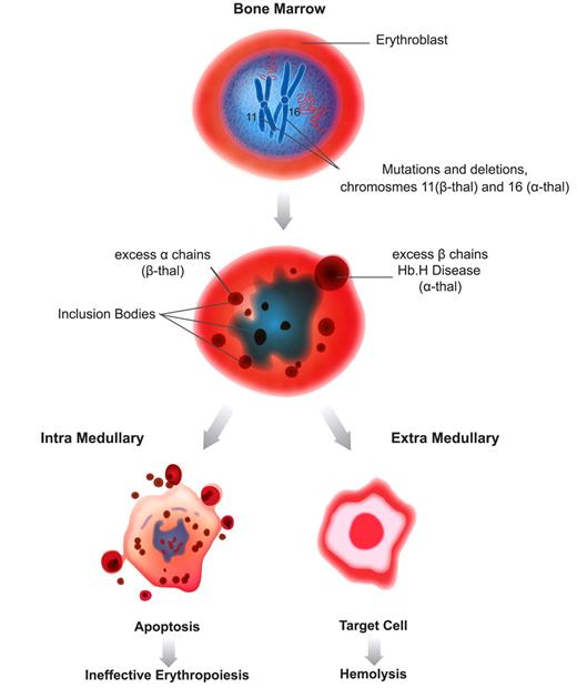 Figure 1. Mechanism of IE and hemolysis in thalassemia.