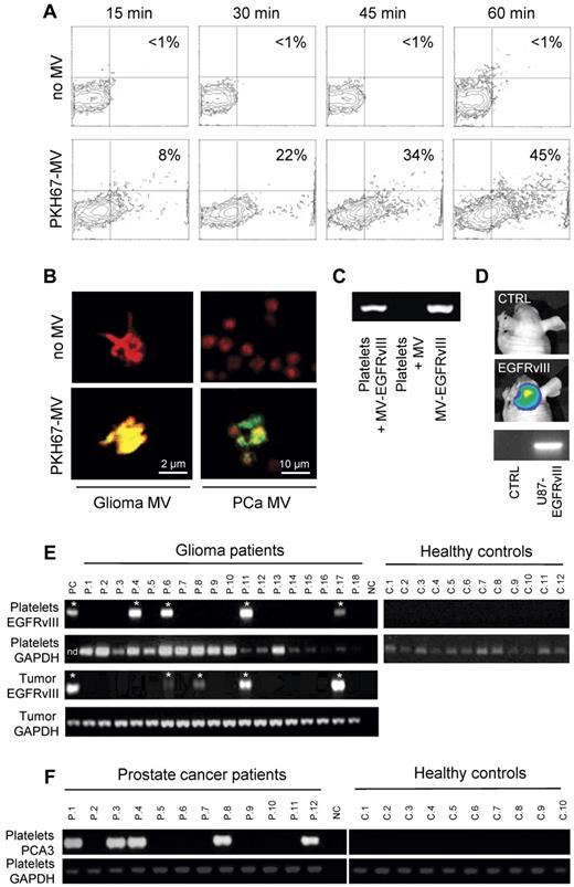 Figure 1. Uptake of tumor-derived RNA in platelets. (A) U87 glioma-derived microvesicles were labeled with PKH67 green fluorescent dye and incubated with isolated platelets. After 15, 30, 45, and 60 minutes of incubation in the presence and absence of microvesicles, the platelets were washed and subjected to FACS analysis of PKH67 fluorescence. (B) Platelets were incubated with PKH67-labeled microvesicles (MV) from glioma or prostate cancer (PCa) patients, stained with Texas-red wheat germ agglutinin, and analyzed by confocal microscopy for PKH67-labeled microvesicle uptake. Merged images and size bars are shown. (C) RNA was isolated from RNAse-treated platelets after incubation with U87 glioma-derived microvesicles under different conditions. RT-PCR was performed to detect EGFRvIII RNA. MV/MV-EGFRvIII indicates microvesicles isolated from U87/U87-EGFRvIII cells. (D) Mice were implanted with U87-Fluc-EGFRvIII cells or no cells and imaged after 2 weeks. Shown are representative bioluminescence images and corresponding EGFRvIII RT-PCR on mouse platelets. (E) RNA was isolated from platelets from 12 healthy control subjects and 26 glioma patients (only 18 patients shown here) and subjected to RT-PCR analysis. Corresponding glioma tissue biopsies served as control. Platelet activation and heterogeneous EGFRvIII tissue distribution may have caused the possible false-negative signals. PC indicates U87-EGFRvIII RNA; NC, H2O; and nd, not determined. *Positive signal. (F) RNA was isolated from platelets from healthy control subjects (n = 10) and prostate cancer patients (n = 12) and subjected to PCA3 and GAPDH RT-PCR analysis.