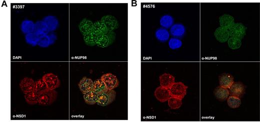 Figure 2. Aberrant nuclear-staining pattern of NUP98/NSD1-positive samples. Immunofluorescence of leukemic cells with antibodies directed against the N-terminus of NUP98 (green) and the C-terminus of NSD1 (red) is shown for a NUP98/NSD1-positive (A) and a NUP98/NSD1-negative patient sample (B). Patient 3397 shows a pattern of nuclear speckles for NUP98 staining as well as NSD1 staining, indicating accumulation of the NUP98/NSD1 fusion protein in aggregates in the nucleus, in contrast to patient 4576. DAPI indicates 4,6-diamidino-2-phenylindole.
