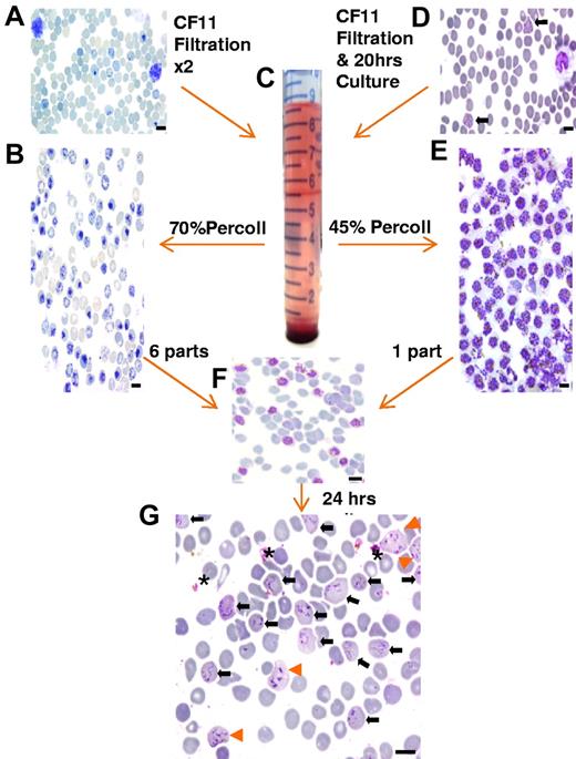 Figure 1. An overview of the assay methodology. Thin smears stained with new methylene blue (A-B) or Giemsa (D-G) illustrating the key methodologic steps of the ex vivo P vivax invasion assay. (A) Cord blood at collection contains a mixture of normocytes, reticulocytes, and leukocytes. (B) After 2 rounds of leukocyte depletion on a CF-11 cellulose column, reticulocytes form the majority of the cells present in the band (seen at the 5.5-mL mark on the tube pictured in panel C) obtained by enrichment on a 70% Percoll cushion. (D) Thin smear showing mature trophozoites (black arrows) and leukocytes typically observed from P vivax isolates collected from patients. (E) Typical yield of concentrated mature P vivax parasites obtained on a 45% Percoll cushion (from a band similar to the one depicted in panel C after a single round of leukocyte depletion on CF-11 and 20 hours ex vivo maturation). (F) The concentrated reticulocyte target cells (B) and mature P vivax schizonts (E) are mixed at a ratio of 6:1 for the invasion assay. (G) After culturing for ∼ 24 hours, the invasion assay mixture shows remnants of ruptured schizonts (*), and RBCs newly invaded by one (black arrow) or multiple merozoites (orange arrowhead). Black scale bar on the micrographs corresponds to 10 μm.