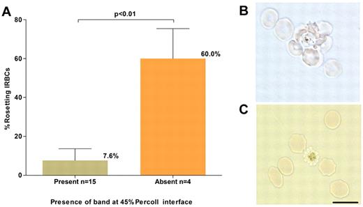 Figure 2. P vivax rosetting and its effect on schizont concentration. (A). The relationship between the percentage of rosetting P vivax IRBCs (in the 20-hour matured isolates) before concentration and presence or absence of a concentrated schizont band at the 45% Percoll interface. (B) A micrograph of an unstained wet preparation showing a P vivax rosette (more than one RBC attached to a central IRBC) collected from the pellet of a isolate that did not yield a band on the Percoll cushion. (C) Rosetting forms were not observed following treatment of the pellet with trypsin, and a band was subsequently obtained on the Percoll cushion. Black scale bar corresponds to 10 μm for both micrographs.