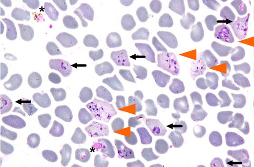 Invasion of enrinched reticulocyte population by Plasmodium vivax. Cells invaded by either one (black arrow) or multiple merozoites (orange arrowhead) after 24 hours of in vitro culture are shown (from Figure 5 of Russell et al1).