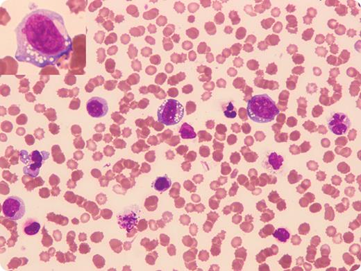 A 9-year-old boy was diagnosed with stage III ALK-positive anaplastic large cell lymphoma (ALCL) with no evidence of bone marrow and central nervous system disease. / Seven months later he had a normocytic anemia (hemoglobin 79 g/L), severe thrombocytopenia (platelets 15 × 109/L), and leukocytosis (white blood cell count 50.8 × 109/L). The automated differential showed neutrophils 28.5 × 109/L, monocytes 13.2 × 109/L, and “other” cells 4.6 × 109/L. The peripheral blood smear (shown) contained large immature cells with basophilic cytoplasm and prominent cytoplasmic vacuolation. Karyorrhexis, pyknosis, and karyolysis were also seen in the large immature cells. Red blood cell morphology showed numerous echinocytes (also known as burr cells), which were likely a consequence of renal failure (creatinine 162μM, urea 12.9mM). / Flow cytometric immunophenoptyping on the peripheral blood showed that 55% of the cells expressed CD30, HLA-DR, and partial CD13. The cells expressing bright CD30 also expressed CD25. A diagnosis of leukemic transformation of ALCL was made. Microscopic review of the peripheral smear clarified the “automated differential” that was inaccurately reported.
