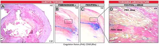 Figure 5. Staining of FXII(a) and fibrin(ogen) in human carotid thrombi. Representative images of 3 human carotid thrombi. (A) Overall figure: H&E staining. (B) Immunohistochemical double staining for fibrin(ogen) and CD68 (staining for monocytes/macrophages). (C-D) Immunohistochemical double staining for FXII(a) and CD68 of a human carotid thrombus. (D) The FXII/FXIIa-positive and negative areas are outlined. Original magnifications: A, 2.5; B-C, 10; and D, 40.