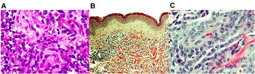 Figure 1. Histologic appearance of EM leukemia. (A) Hematoxylin and eosin staining of a MS along the right psoas muscle (original magnification ×40), demonstrating blasts in the skeletal muscle. Dense dermal infiltrate of monocytic leukemic cells (B; original magnification ×10; C: original magnification ×40), consistent with LC. Images were captured by the Olympus BX 41 microscope using an Olympus DP20 camera (Olympus) and imported directly as a series of .tif files.