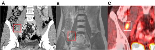 Figure 3. Radiographic appearance of MS. MS along with the path of the right femoral nerve on (A) coronal computed tomography imaging, (B) coronal axial T1 postmagnetic resonance imaging, and (C) positron emission tomography.