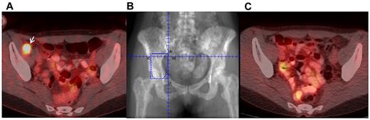Figure 4. Radiation therapy treatment field design and response. (A) MS in the right pelvis on positron emission tomography. (B) Radiation field treated to 24 Gy. Positron emission tomography scan 2 months after radiation, demonstrating resolution of lesion.