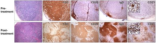 Figure 4. Lymph node biopsies from patient 3 taken before (top) and during treatment (bottom) with rCD40L. Pretreatment, CD3 immunostaining reveals paracortical hyperplasia. Immunostaining with anti-CD20, IgD, and CD21 shows a paucity of B cells and diminutive primary follicles. With rCD40L treatment, a reorganization of lymph node architecture is noted. CD3-positive T cells are now primarily located in parafollicular region, whereas B cells are located in organized primary follicles. Development of prominent network of CD21-positive dendritic follicular cells in the primary follicles is also visible with rCD40L treatment. However, the B cells remain invariably naive as evidenced by their expression IgD. The immunostaining pattern of a reference control reactive lymph node is available in supplemental Figure 1.