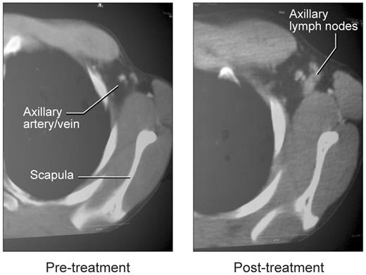 Figure 5. Appearance of lymph nodes in left axilla with rCD40L treatment. Before treatment, the arrow indicates the location of the axillary artery and vein on contrast-enhanced CT studies. The image on the right shows emergence of axillary nodes.