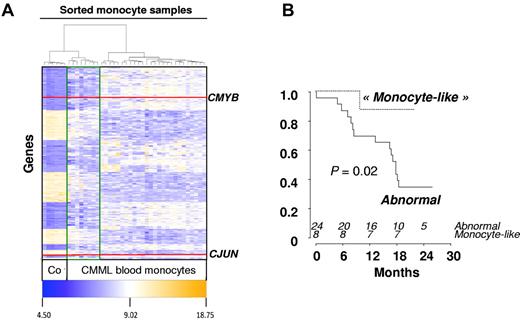 Figure 2. Gene expression in sorted CMML monocytes. (A) Heatmap of 1803 genes differentially expressed between healthy donor (n = 6) and CMML-sorted monocytes (n = 36; fold-change > 2; P < .05) results from a supervised analysis based on Euclidian distances. Red lines indicate CMYB and CJUN genes. Unsupervised analysis had previously identified 2 groups of CMML patients: those with a “normal monocyte-like” (highlighted with a green line, n = 8) and those with an “abnormal” (the others, n = 24) signature. (B) Kaplan-Meier survival estimates of OS according to the “normal monocyte-like” compared with the “abnormal” signature.