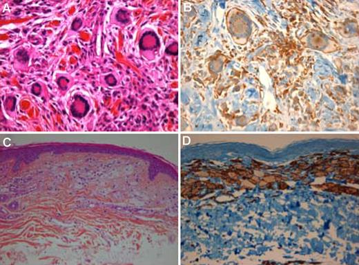 Figure 2. Skin biopsies of patients with NXG and NX. Touton giant cells (hematoxylin coloration; A) with positive staining for CD163 in immunohistochemistry in NXG (B). (C) Dermal infiltration by spumous cells. (D) Positive staining for CD163 in NX. Images were acquired with an Olympus Bx51 microscope (A, 20×/0.5; B, 20×/0.5; C, 5×/0.16; and D, 5×/0.16) in Axiocam MRc (Zeiss; Axiovision 4.8.2).