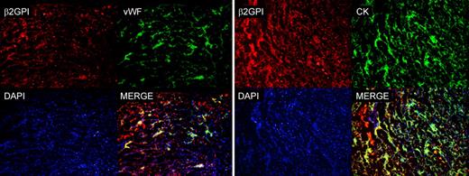 Figure 4. Analysis of sections of implantation sites isolated from pregnant mice by atomic force microscope for the presence of β2GPI-Cy5.5 and by fluorescence microscope for the presence of CK and VWF. Note the colocalization of β2GPI-Cy5.5 and VWF on ECs and β2GPI-Cy5.5 and CK. The cell nuclei were stained with DAPI. Original magnification 100×.