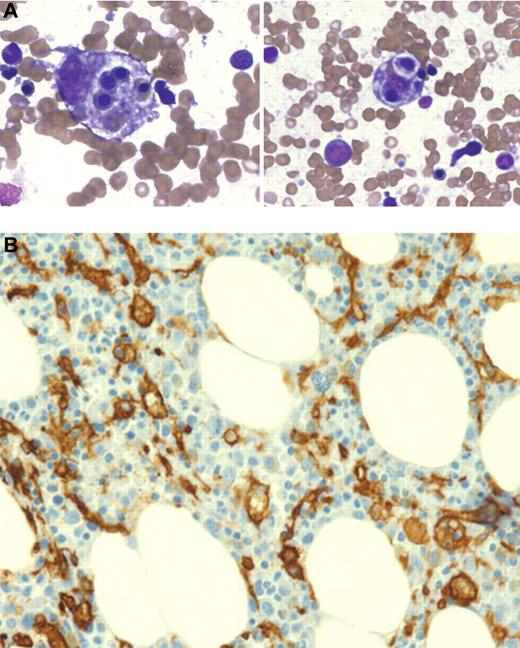 Figure 4. Hemophagocytosis on bone marrow aspirate and biopsy. (A) Two examples of hemophagocytic macrophages identified on bone marrow aspiration (Wright-Giemsa stain). (B) CD163 staining of bone marrow biopsy section highlights hemophagocytosis (counterstained with hematoxylin). Images were taken on a Nikon Elipse microscope (panel A: 100×/10; panel B: 20×/10) without oil, with a Spot digital camera. Images are unmanipulated. Courtesy of Dr Jun Mo.